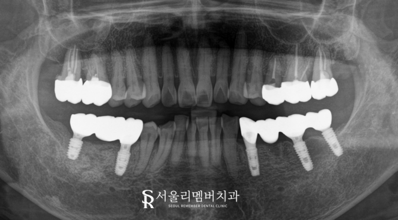 봉천동 치과 상실된 치아 방치하면 안 되는 이유 (feat.임플란트 브릿지 보철치료) 관련 이미지 6