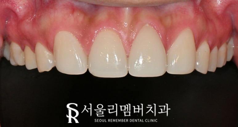 서울대입구 치과 결손된 앞니 자연스러운 라미 리얼네이트로 변색 레진과 사이 공간 막을 수 있다면 관련 이미지 5