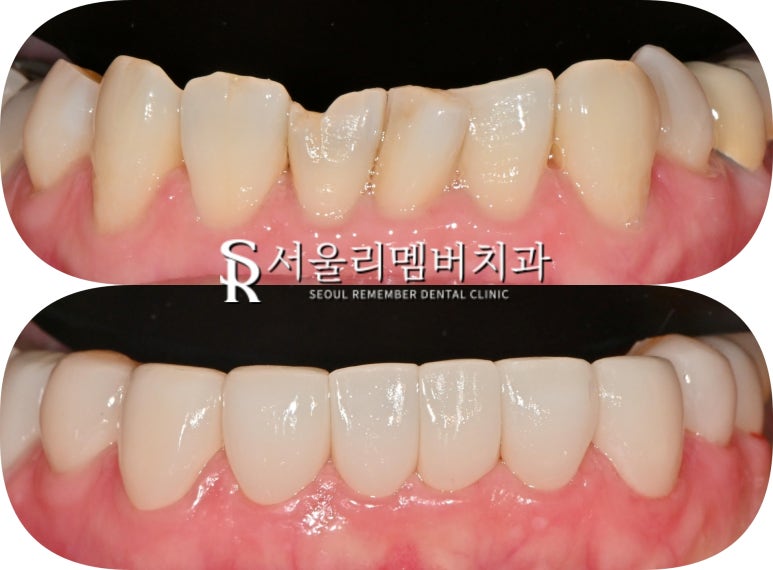중년 치열 틀어짐 및 파절과 변색, 봉천동 치과 치아교정 대신 심미보철 치료 (임플란트 크라운 라미네이트 복합 증례) 관련 이미지 7