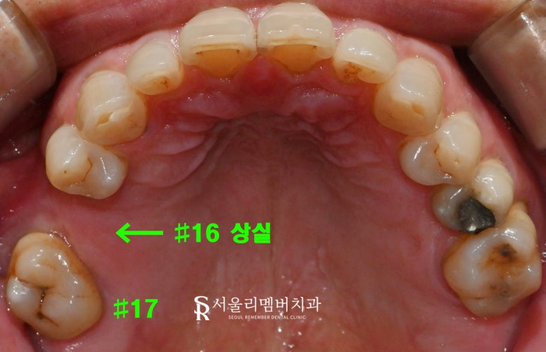 "이제 밥 먹는 것도 문제없어요!" 낙성대 치과 임플란트 로 새로운 구강 환경 찾아 드린 사례 관련 이미지 1