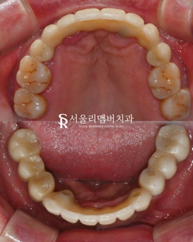 신림역 치과 "틀니는 쓰기 싫어요." 전체 임플란트 식립 후기 관련 이미지 7