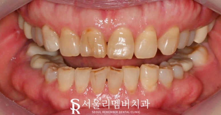 상도동 치과 누렇게 보이는 앞니 6전치 심미보철 라미 리얼네이트로 밝고 자연스럽게 개선한 사례 관련 이미지 2