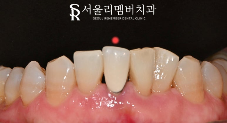 신림 치과 오래된 아래 앞니 PFM 크라운 치경부 금속 비침과 치근단 병소로 신경치료 후 지르코니아 심미보철 수복 관련 이미지 2