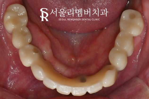 "잇몸에 고름이 차고 흔들려요!" 서울대입구 임플란트 디지털 진료로 치료한 사례 관련 이미지 4