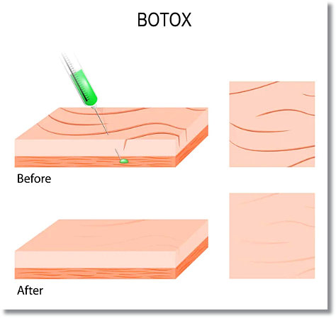 Are you worried about Botox resistance and side effects in Sinchon? image 3