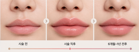 마포구필러 전 알아둘 입술 볼륨 개선 효과와 부기·유지기간 관련 이미지 5