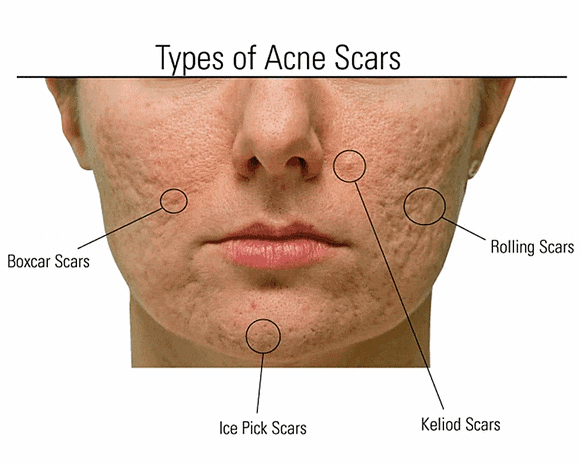 Hongdae Acne Dermatology: Can You Recover Smooth Skin Without Scarring? image 7