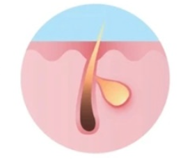 홍대여드름치료, 반복적인 재발 막기 위한 루틴 3가지 관련 이미지 6