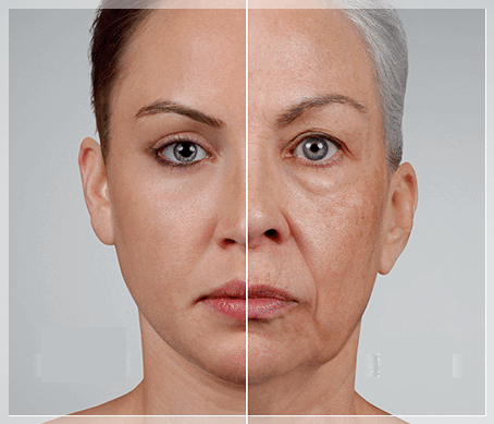 Recommended Dermatology Treatments in Shinchon That Vary Depending on the Pattern of Loss of Skin Elasticity image 3