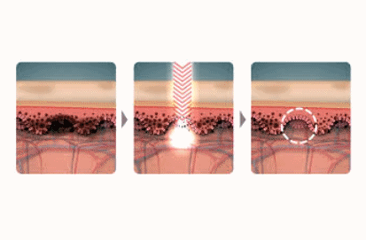 Three Key Factors That Truly Determine the Effectiveness of Pico Toning in Hongdae image 2