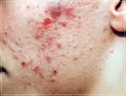 Why does acne keep recurring even after treatment at a Sinchon acne dermatology clinic? image 1
