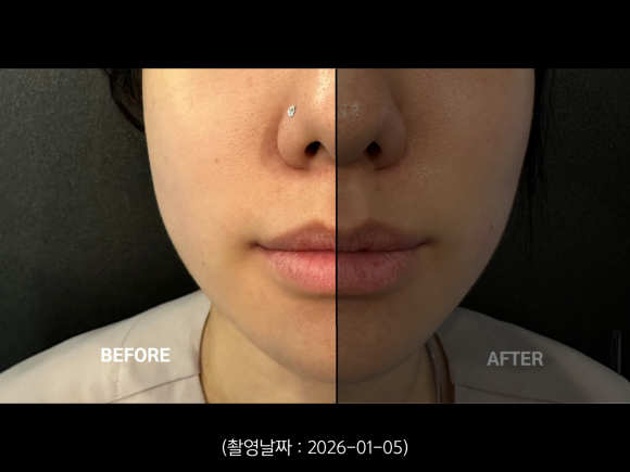 A Case of Improving a Round Jawline with the Tentriple Lift at Sinchon image 1