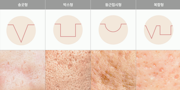 홍대여드름흉터 시술은 어떻게 진행되고, 몇 회 정도 필요할까요? 관련 이미지 2