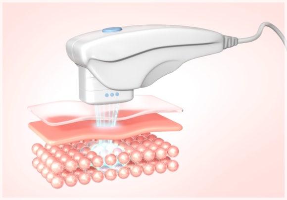 Ulthera and Density Combination: What Effects Can It Have? image 4