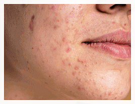 Why Do Recommended Dermatology Treatments in Mapo-gu Need to Be Repeated Several Times Before Their Effects Appear? image 3