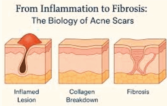 Sinchon Acne Scars: How They Are Treated by Type image 2