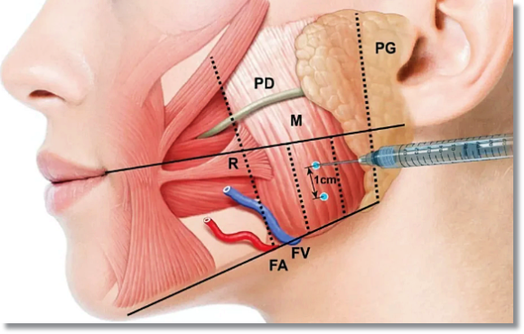 Are you worried about Botox resistance and side effects in Sinchon? image 4