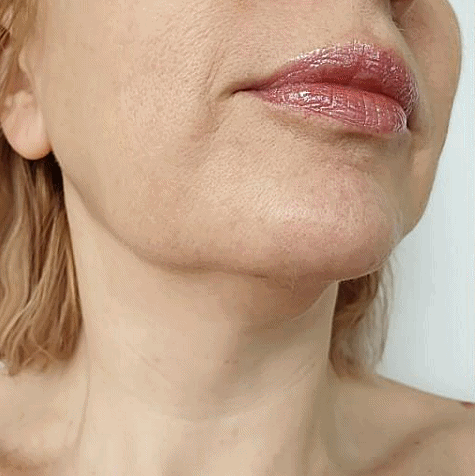 Can Onda Lifting at a Hongdae Dermatology Clinic Improve Nasolabial Folds and Sagging Jawlines? image 2