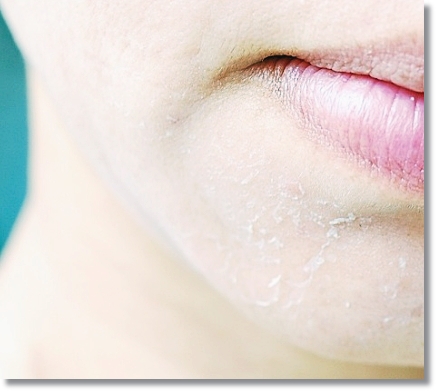 Must-Read If You’re Considering Aqua Peel for Sebum Concerns in Sinchon image 1