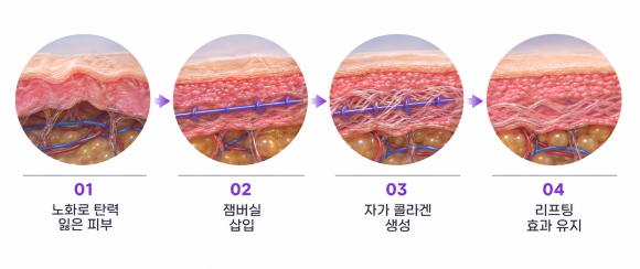 홍대실리프팅, 꺼진 부위도 채울 수 있을까? 잼버실 시술 원리와 주의사항 관련 이미지 6
