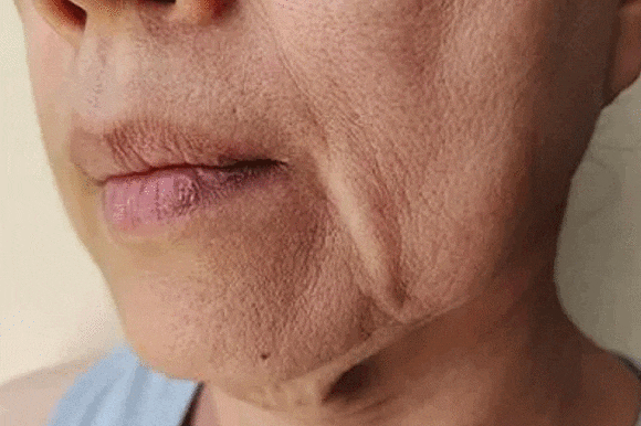 Hongdae Density Lifting: The Core Principles of RF Laser and Firming Effects image 1