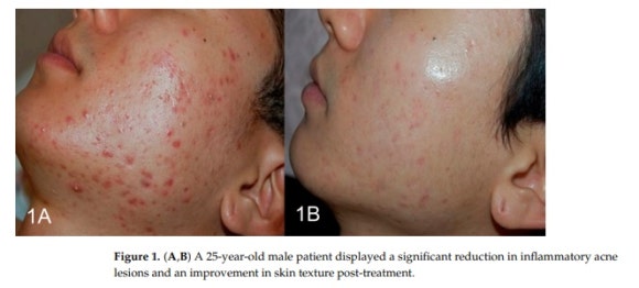Potenza and Exosome Combination: What Skin Is It Effective For? image 5