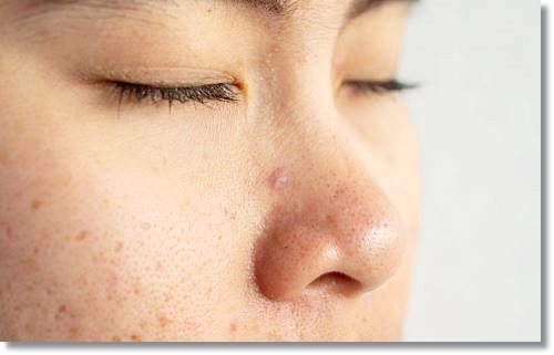 Is It Not Good to Get Skin Planning Too Often? image 1