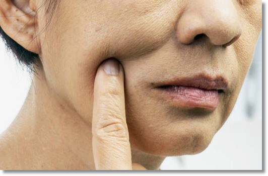 The Truth and Myths About Cheek Hollowing After Vero Lifting image 3
