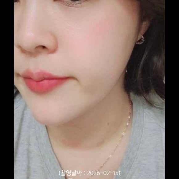 Hongdae Hiko Nose Thread Lifting Procedure Case image 1