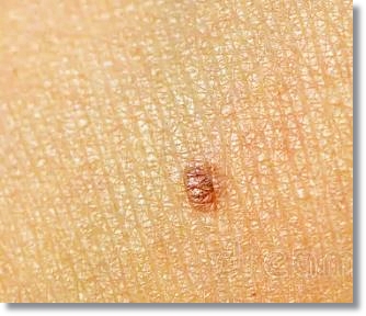 Must-Read If You’re Concerned About Melasma and Dark Spots: Pico Toning in Hongdae image 6