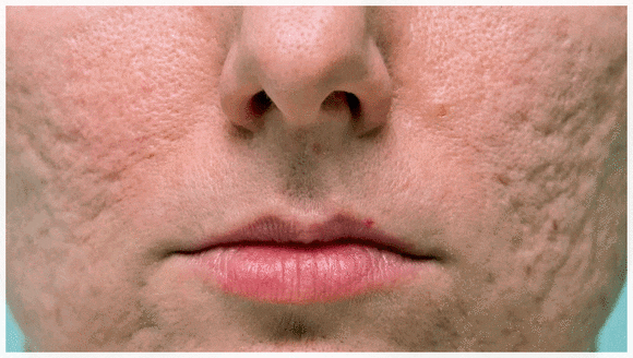 Hongdae Acne Dermatology Clinic: When Is the Right Time to Start Treating Acne Scars in Adolescents? image 3
