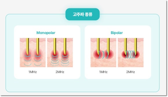 포텐자 리프팅 효과가 좋은 이유는? 관련 이미지 3