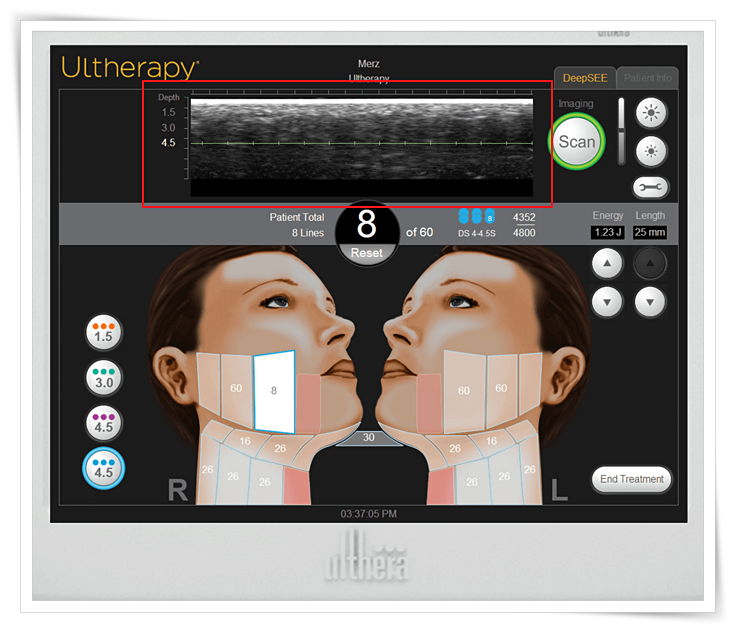 Shinchon Ulthera: Important Precautions You Must Know Before Getting It image 8