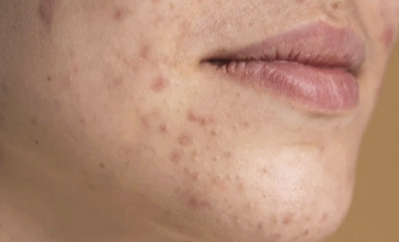 Hongdae Acne Extraction: 3 Things You Must Check image 5