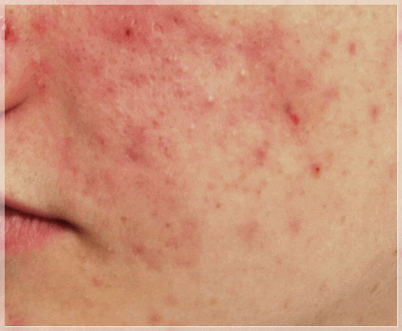 Hongdae Acne Dermatology Clinic: When Is the Right Time to Start Treating Acne Scars in Adolescents? image 5