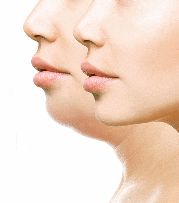 Hongdae Shurink Universe: How Is It Different from Existing Lifting Treatments? image 6