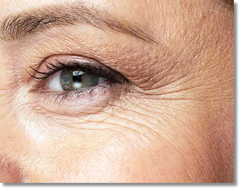 Are you worried about Botox resistance and side effects in Sinchon? image 1
