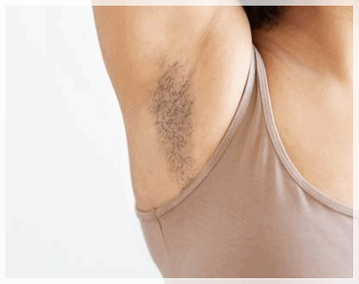 Sinchon Laser Hair Removal: Why a 5-Session Package May Not Be Enough image 5