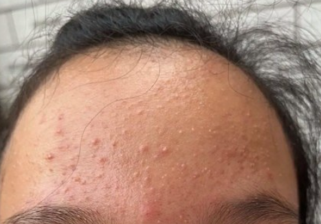 홍대여드름치료, 반복적인 재발 막기 위한 루틴 3가지 관련 이미지 2