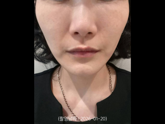 Case of Improving Nasolabial Folds and Sagging Deep Cheeks with Onda Lifting near Hongik Univ. Station image 2