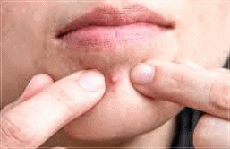 Why does acne keep recurring even after treatment at a Sinchon acne dermatology clinic? image 3