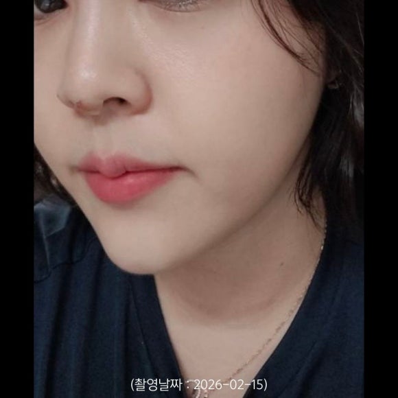Hongdae Hiko Nose Thread Lifting Procedure Case image 2