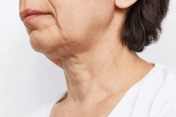 Considering Sinchon InMode or Ultherapy?! image 8