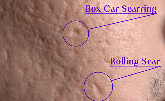 Hongdae Acne Dermatology: Can You Recover Smooth Skin Without Scarring? image 8