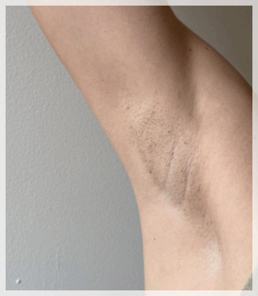 Hongdae Underarm Hair Removal: 3 Factors That Determine Satisfaction image 7