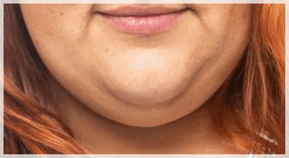 Hongdae InMode: Why the Effects of Forma and FX Must Be Properly Distinguished When Choosing Treatment image 4