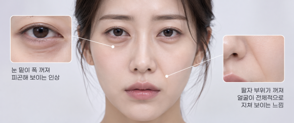 홍대실리프팅, 꺼진 부위도 채울 수 있을까? 잼버실 시술 원리와 주의사항 관련 이미지 2