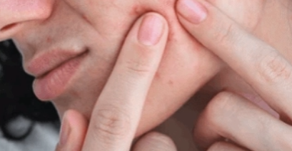 Hongdae Acne Extraction: 3 Things You Must Check image 7