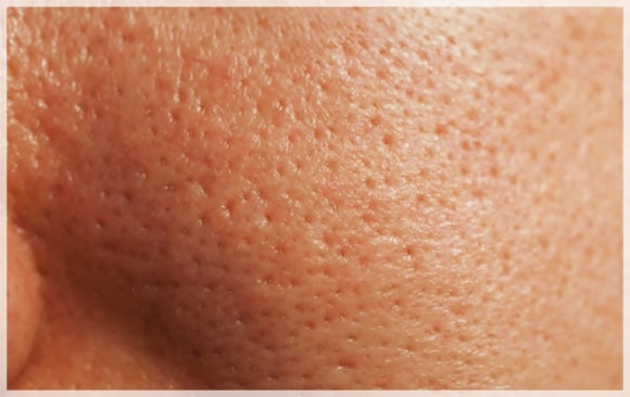 If You’re Worried About Enlarged Pores in Hongdae Potenza, Read This First image 1