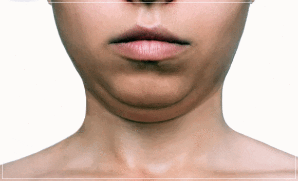 Double Chin Lifting in Hongdae: A Changing Facial Contour — Which Procedure Is Right for My Face Shape? image 1